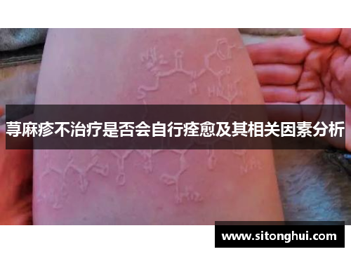 荨麻疹不治疗是否会自行痊愈及其相关因素分析
